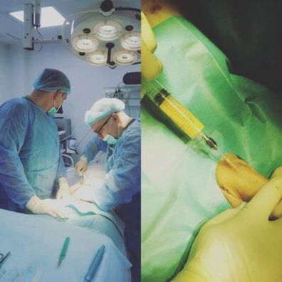 Verdikking van de penis is mogelijk met behulp van een operatie