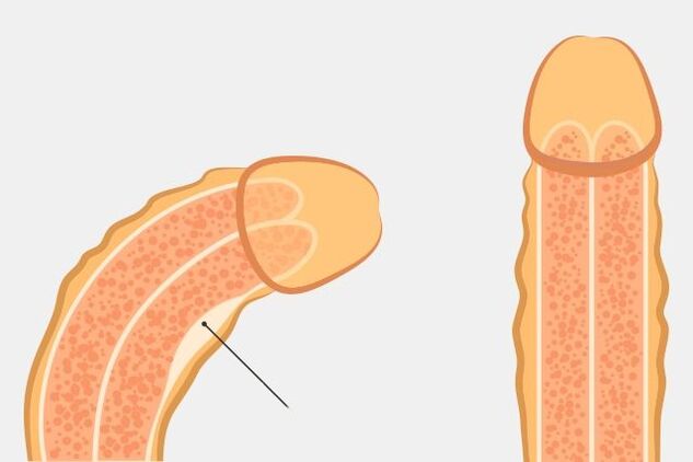 effectieve manier om de penis recht te maken