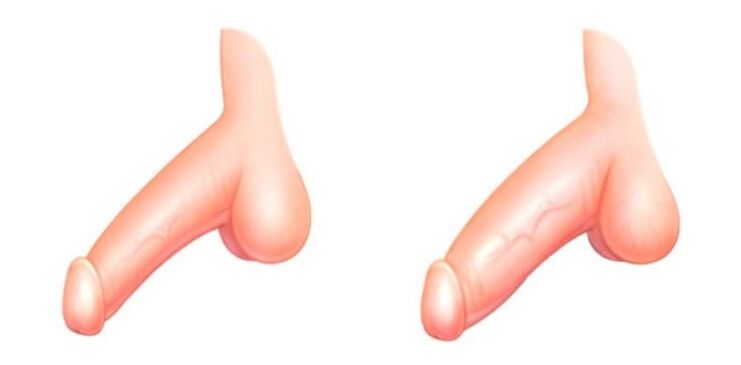penis voor en na de vergroting
